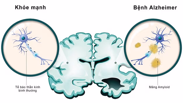 Bệnh Alzheimer có di truyền không? Giải mã vai trò của gen và 1 số yếu tố nguy cơ