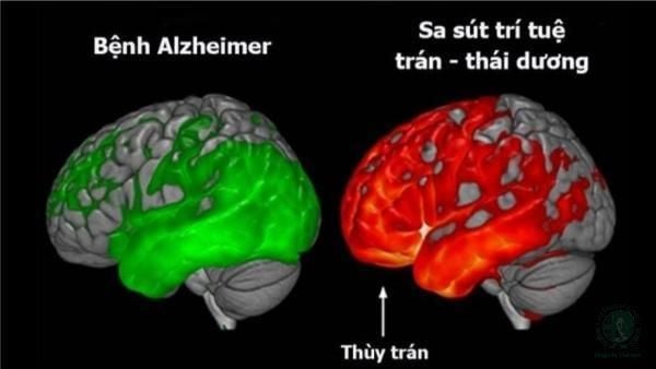 sa sút trí tuệ và bệnh Alzheimer
